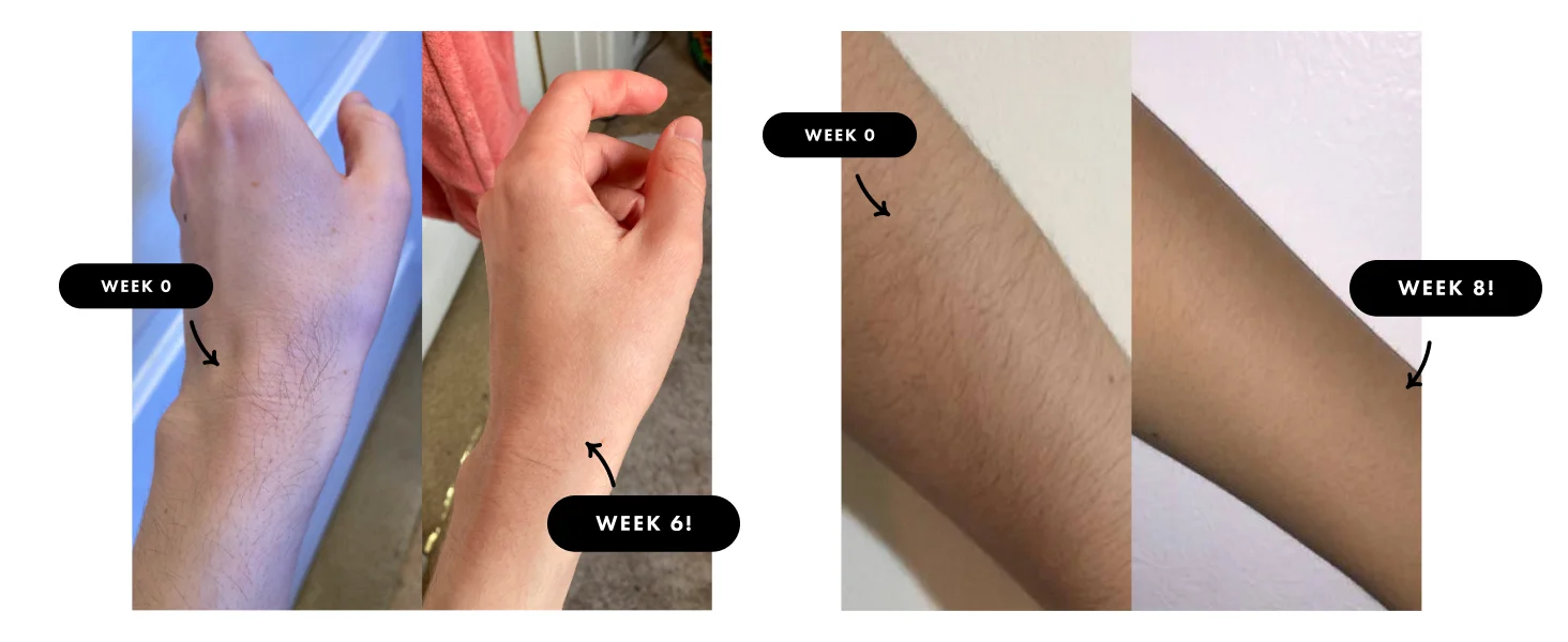 9-Level Ice-Cooling IPL Hair Remover – Painless, Permanent Smooth Skin at Home