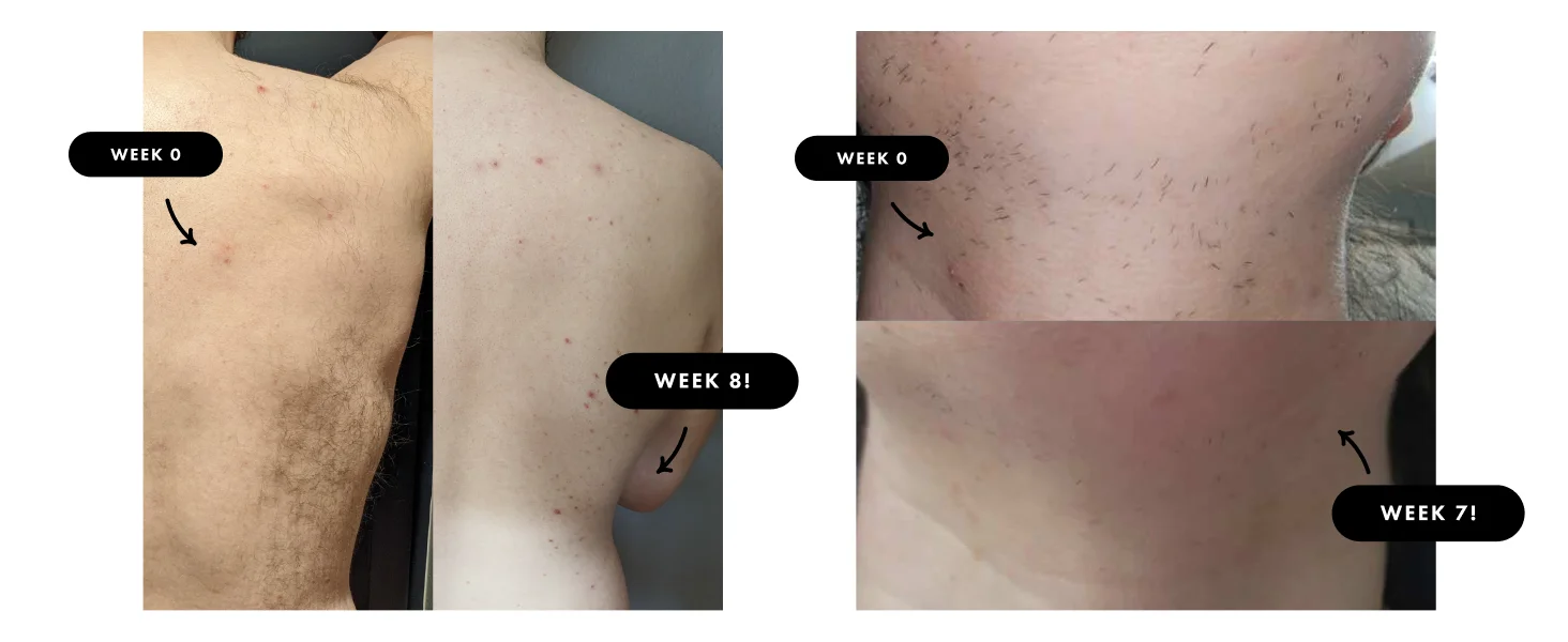 9-Level Ice-Cooling IPL Hair Remover – Painless, Permanent Smooth Skin at Home