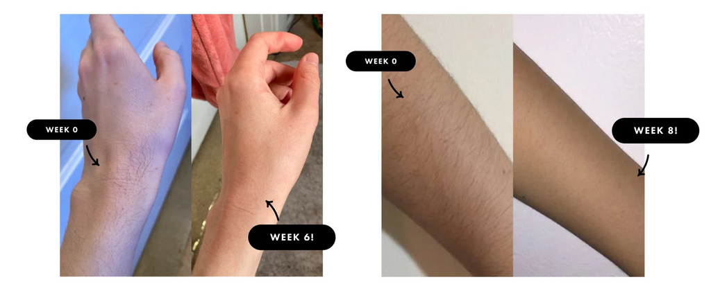 9-Level Ice-Cooling IPL Hair Remover – Painless, Permanent Smooth Skin at Home