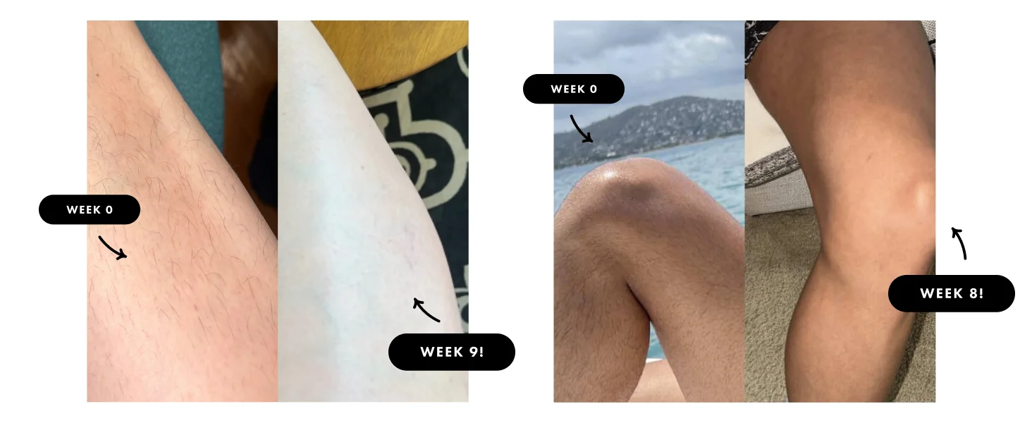 9-Level Ice-Cooling IPL Hair Remover – Painless, Permanent Smooth Skin at Home